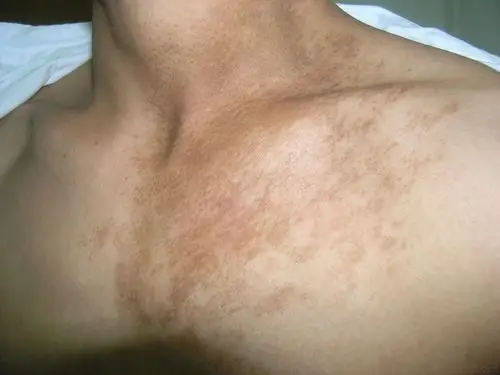 看图识病---公布答案色素性毛表皮痣