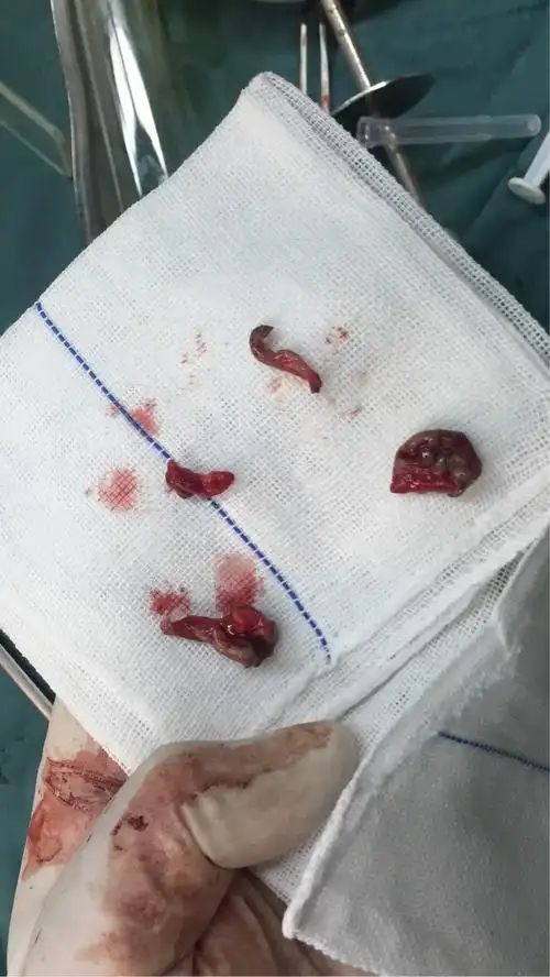 剪除的部分外痔