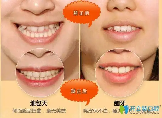 厦门博德口腔地包天和龅牙矫正前后对比照