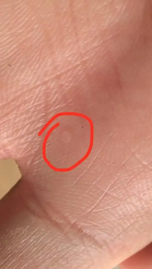 手掌上出现白色透明小疙瘩!那是什么!怎么导致出出现的!