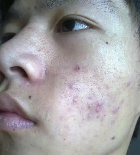 5,痤疮患者尽量少吃脂肪和糖类,应多吃水果和蔬菜,补充身体所含的