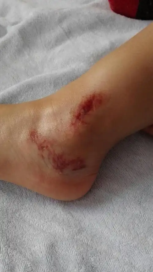 小孩脚被自行车卷到,如果伤到骨头会有什么症状