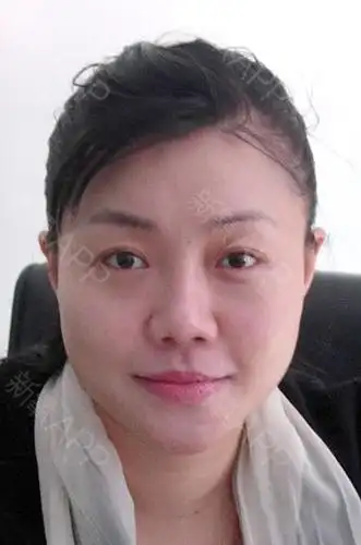 手术前是典型的大饼脸,满脸肉,和很多女孩子一样 每天各种揉搓