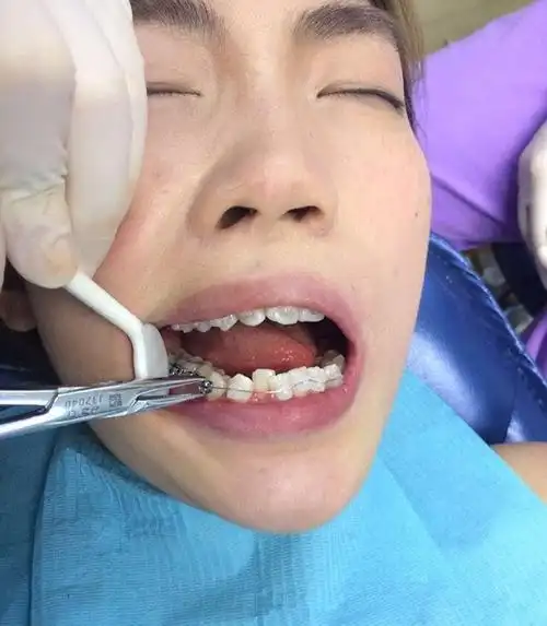 戴牙套的过程还是比较舒适的不会痛主要是嘴张开有点累不过这都不算