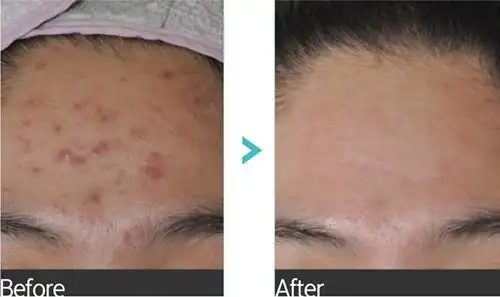 青春痘治疗对比图