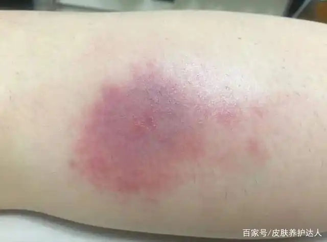 被蚊子咬的包,最好不要抓,挠,掐,一旦抓破皮很容易引起局部感染,甚至