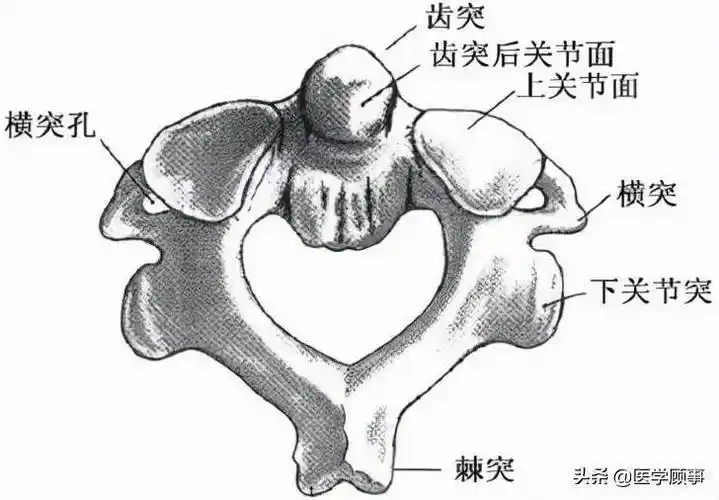 隐秘杀手枢椎齿状突骨折