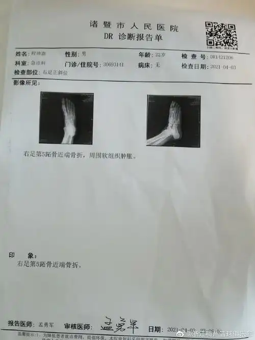 浙江官方程帅澎右足第5跖骨近端骨折赛季报销