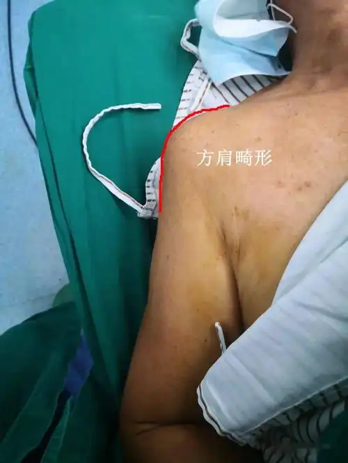 肩关节脱位有什么表现?专家教你如何判断