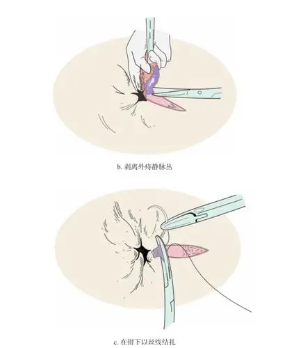 图4—23 静脉曲张性外痔的手术技巧(2)对于多发性外痔,在各切口之间要