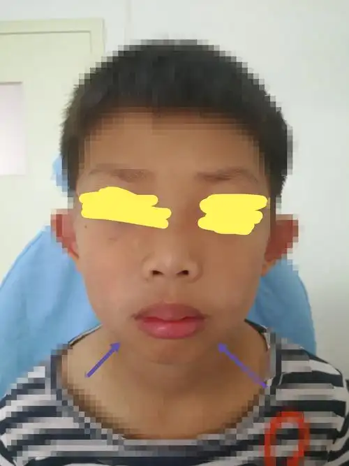 这小朋友扁桃体iii肥大,腺样体肥大,睡觉时张口呼吸,打鼾严重.