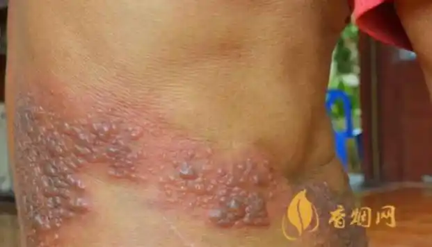 飞蛇疱疹与白酒:真相揭秘及预防方法-香烟网
