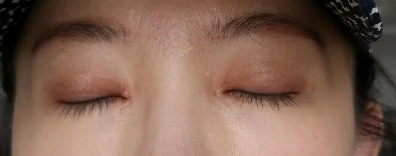 内眼角疤痕开的太大了我这种怎么修复