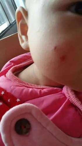 宝宝的脸上虫子咬的包,宝宝用手挠烂了,刚好点就又挠破了,怎么才能