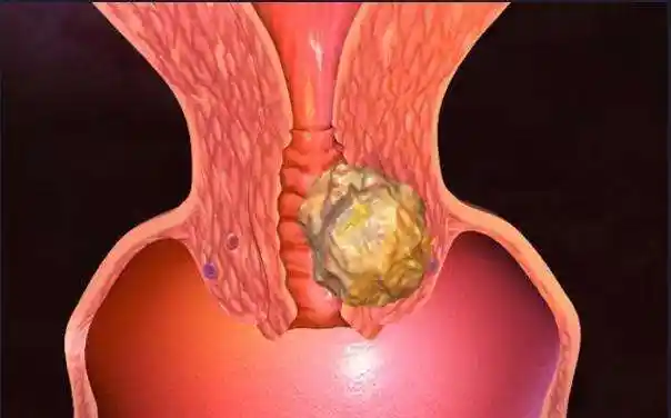 宫颈脱落细胞学检查,可以早期"侦察"到子宫颈癌前病变和子宫颈癌早期