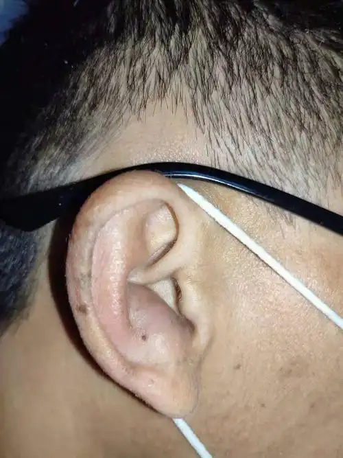 一例耳廓假性囊肿手术治疗 - 病例中心(诊疗助手) - 爱爱医医学网