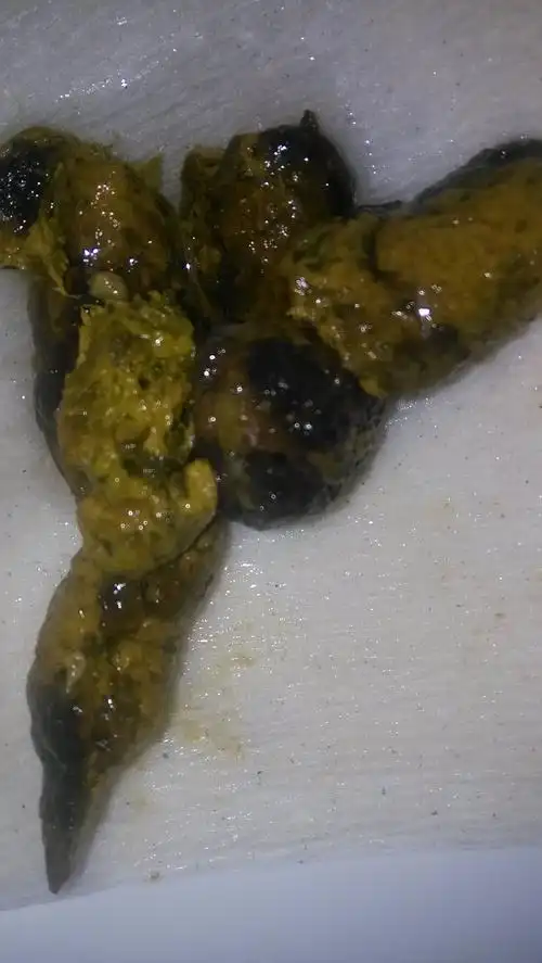 这样大便跟喝了凉茶有没有关系,还有白色油脂物?