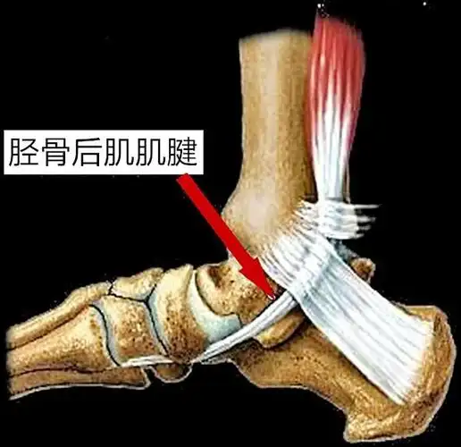 「运动康复」胫骨后肌失能与扁平足-跑者的噩梦_肌腱
