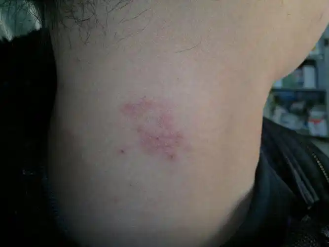 带状疱疹复发一例-----《春季皮肤病病例征集》