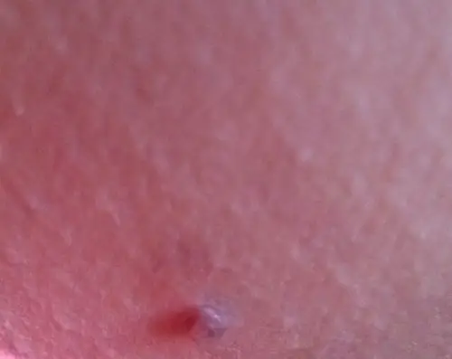 大腿根部皮肤上长了一颗肉丁米粒大小,肉色,不痛不痒也不会变大.