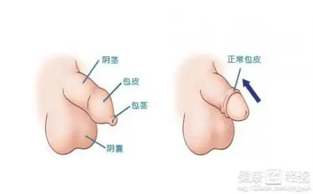 包皮包茎手术步骤要了解
