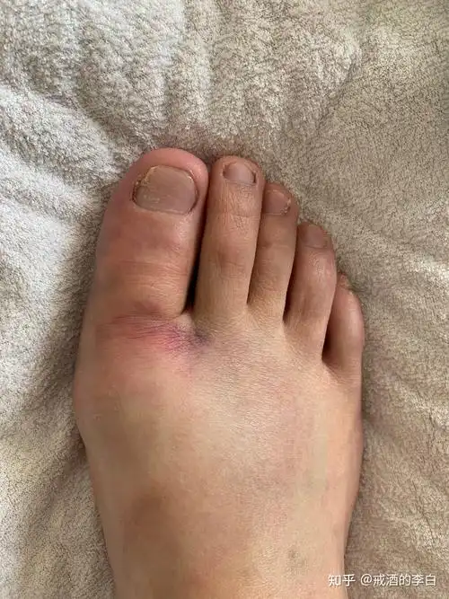 我的右脚大拇指骨折经历连载