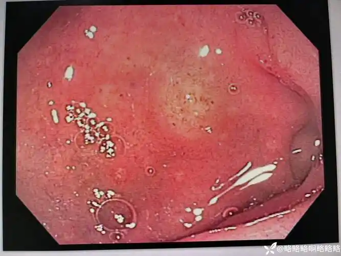 13岁小姑娘腹痛行胃镜检查球部见一隆起