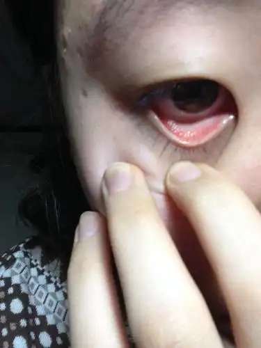 眼角内侧有许多黄色小颗粒组成的异物,发痒.下眼睑接近睫毛处发红.