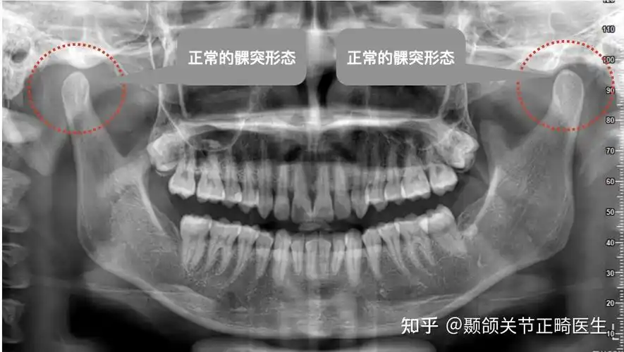 颞下颌关节紊乱为什么要拍核磁共振?