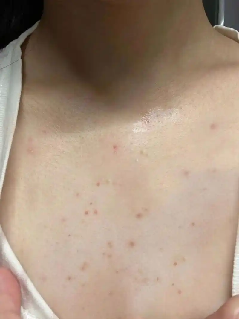 说下我的情况哈:从几个月前开始胸口长痘,密密麻麻的一大片痘痘在