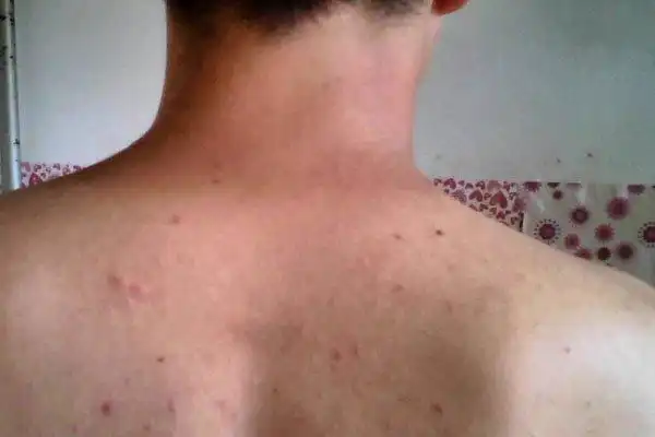 螨虫咬过后的图片从自己里里外外进行各种处理