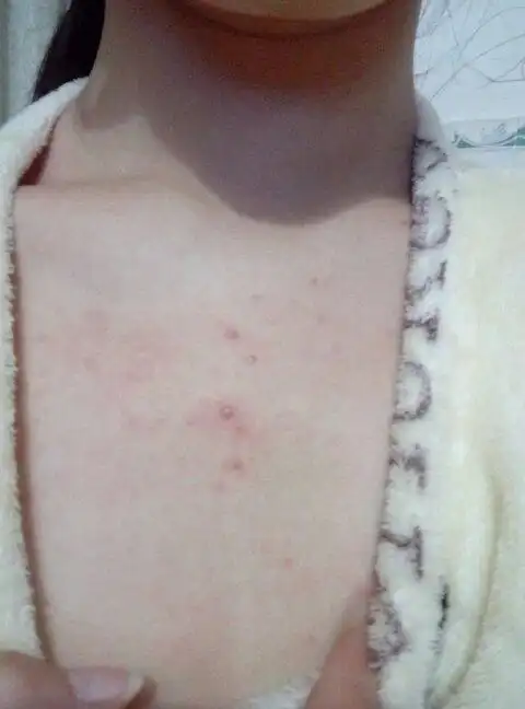 胸口背后长痘痘,这是什么原因啊?怎么治疗呢?