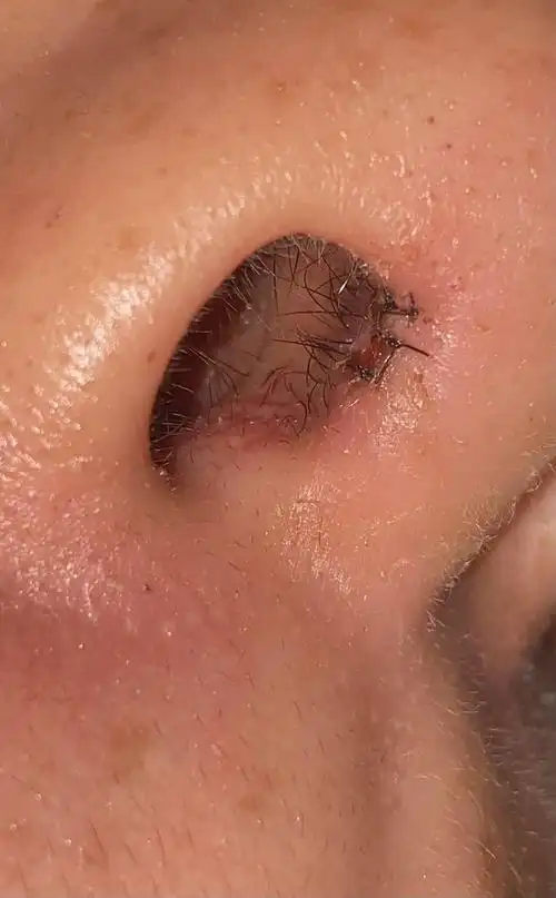 术后天了能拆线了吗清理鼻腔内总是有黄色这个什么东西正常吗