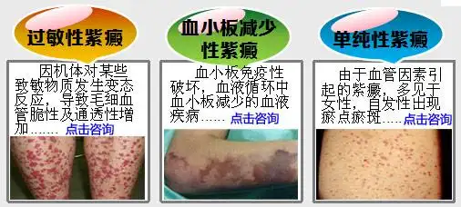 紫癜是什么病?能治好吗?