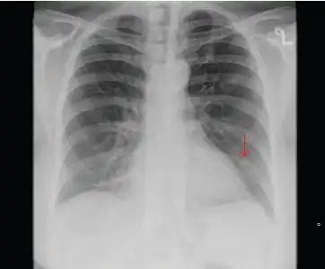 图1:胸片示一个1.3厘米的结节,箭头所示).