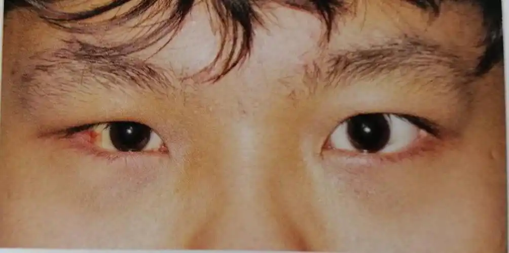 早期可能不明显或眼球突出,肿胀消退,眼球内陷即可显露出来.