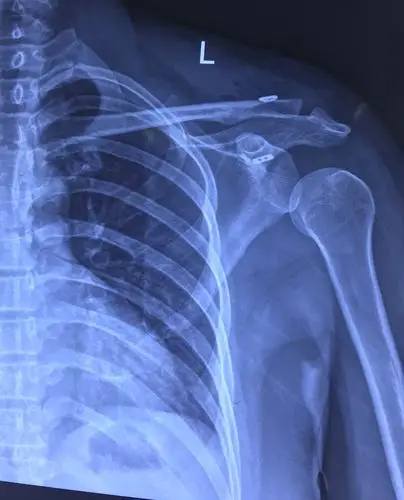 肩锁关节脱位关节镜微创复位固定