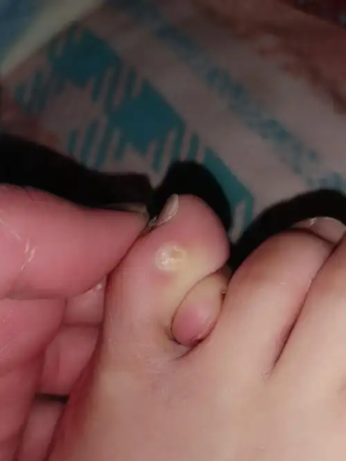 鸡眼被取出来的样子图片(脚上为什么会长鸡眼)_百科-8s新商盟