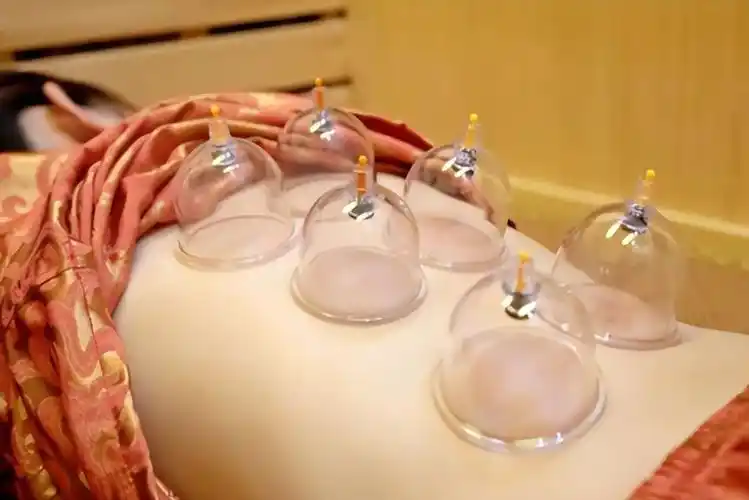 拔罐黑紫色说明什么(女性拔罐两个肩膀头最紫)