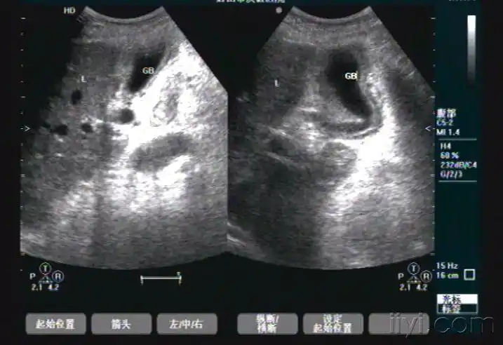 胆囊腺肌症? - 超声医学讨论版 - 爱爱医医学论坛