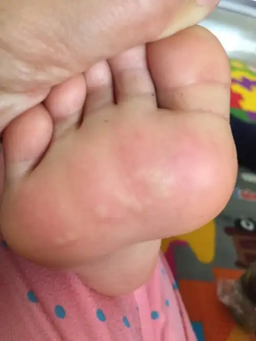 宝宝脚底痒三四天了刚开始以为是被蚊子咬了但是现在图片看来