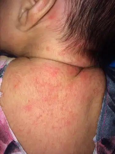 请问宝宝脖子后面这是痱子还是湿疹?如何采取治疗措施?_百度知道