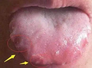 从舌头一眼看是否癌症体质