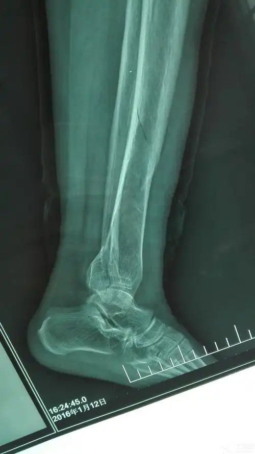 胫骨螺旋形骨折,外踝骨折,后踝骨折 - 骨科专业讨论版 -丁香园论坛