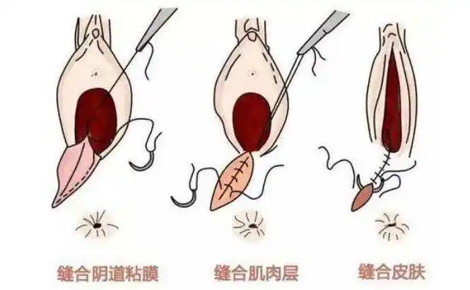顺产下面撕裂缝针多久会好,宝妈们要注意顺产下面撕裂伤口的护理