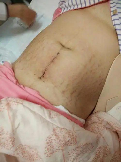 四月二十一号预产期,过了十天剖腹产男宝