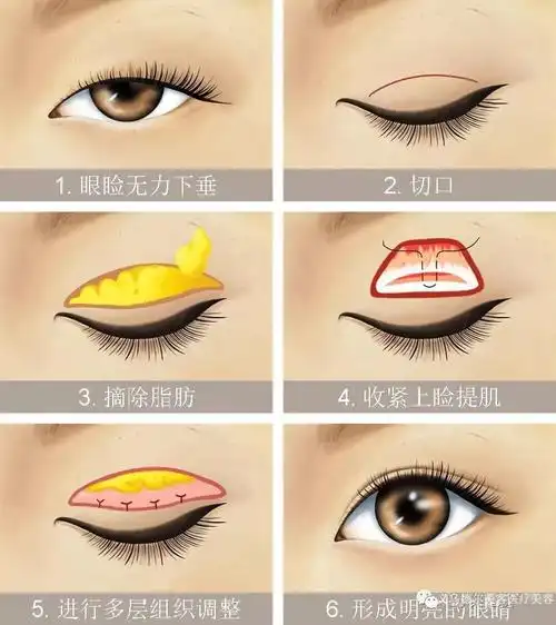 长春美佳铭医上睑提肌缩短术