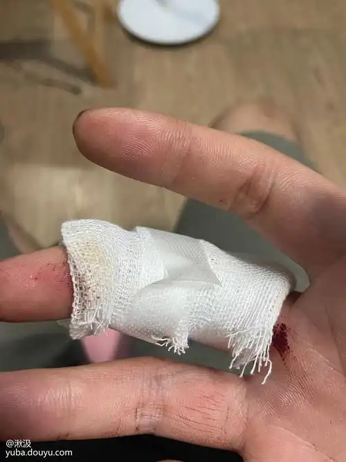 出了点意外兄弟们 手断了! 晚上看情况来吧我他妈难受啊!