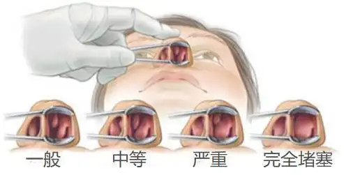 鼻甲肥大需不需要进行治疗