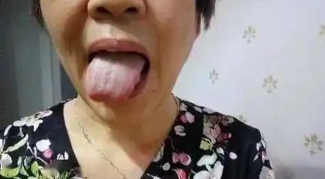舌苔_脾胃_疾病